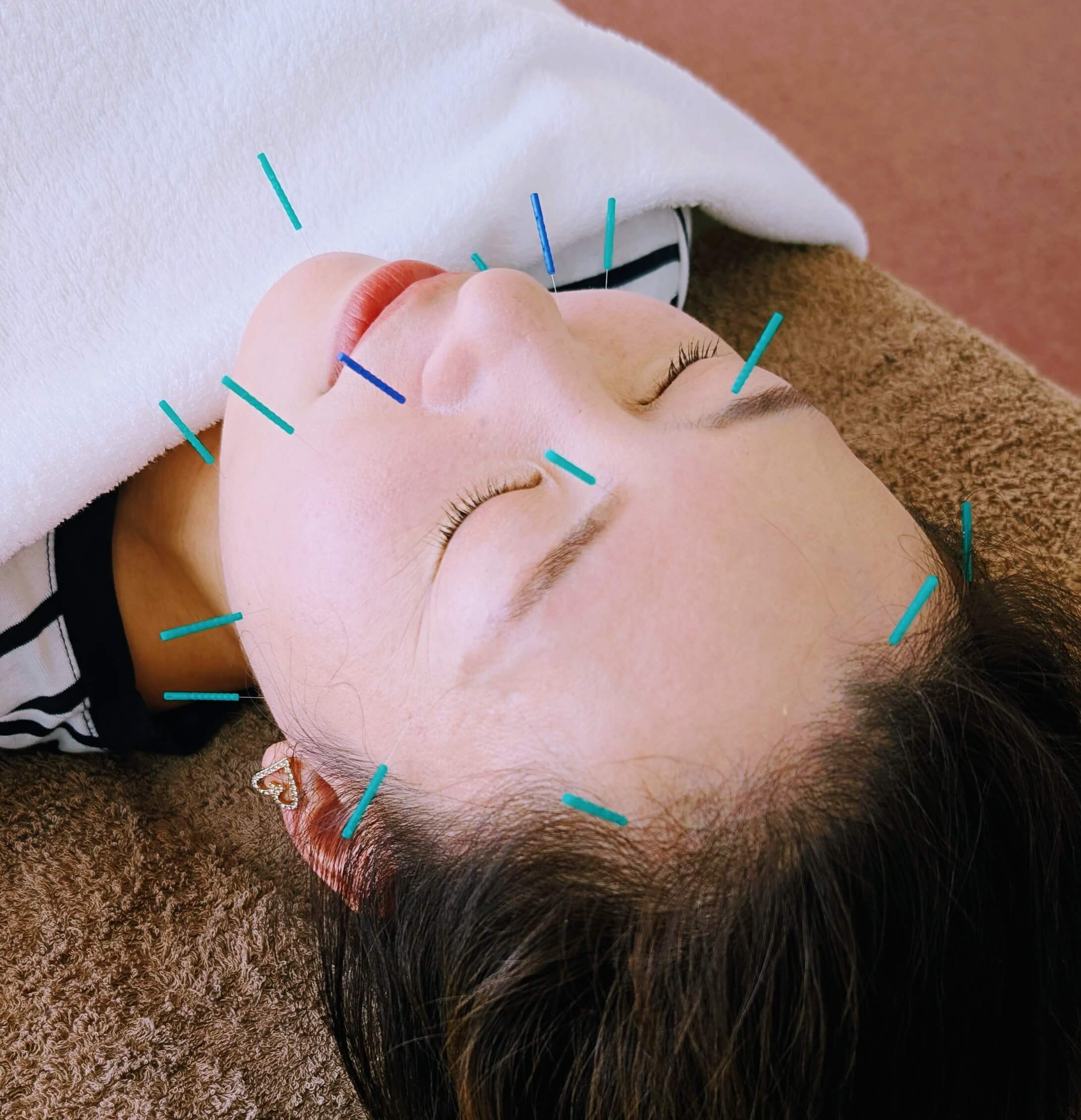 美容鍼の施術風景